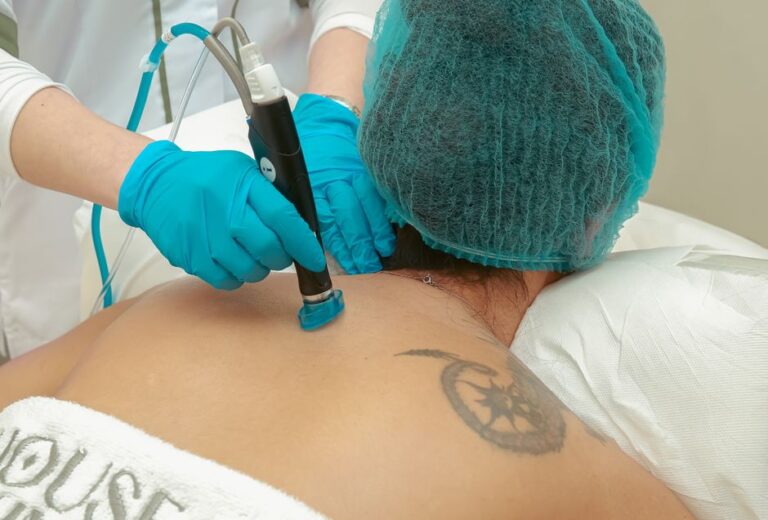 eliminación tatuaje láser
